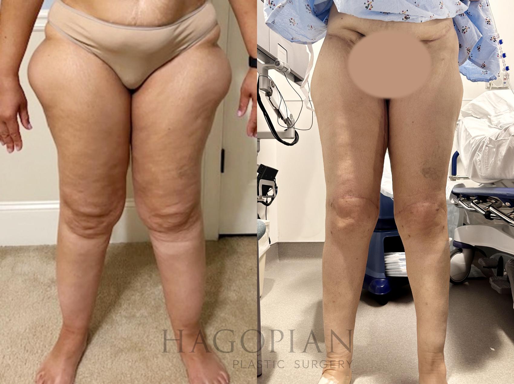Before & After Arm & Thigh Lift Case 85 Front View in Atlanta, GA