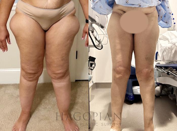 Before & After Lipedema Surgery Case 85 Front View in Atlanta, GA