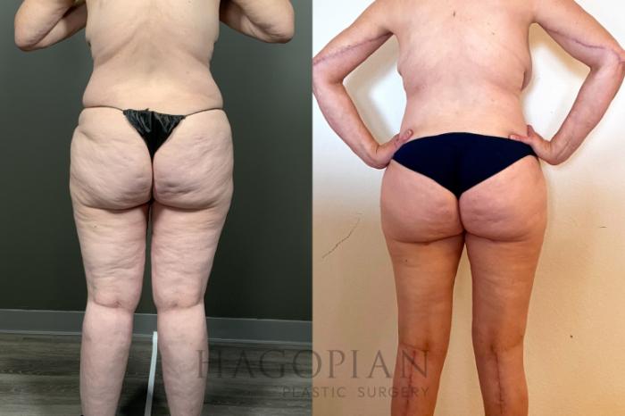 Before & After Arm & Thigh Lift Case 88 Back View in Atlanta, GA