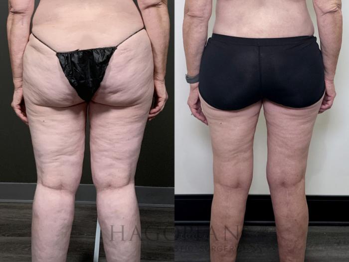 Before & After Arm & Thigh Lift Case 90 Back View in Atlanta, GA