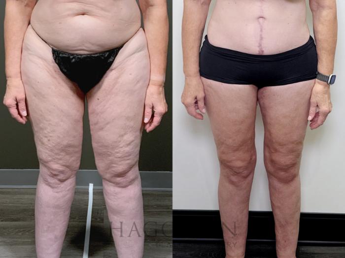 Before & After Arm & Thigh Lift Case 90 Front View in Atlanta, GA