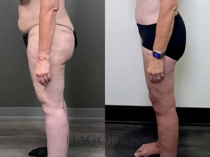 Before & After Arm & Thigh Lift Case 90 Left Side View in Atlanta, GA