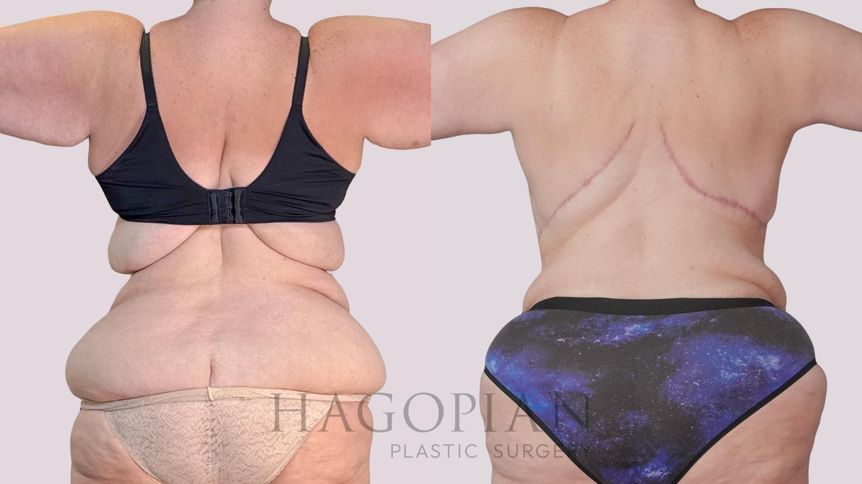Before & After Back Lift Case 285 Back View in Atlanta, GA