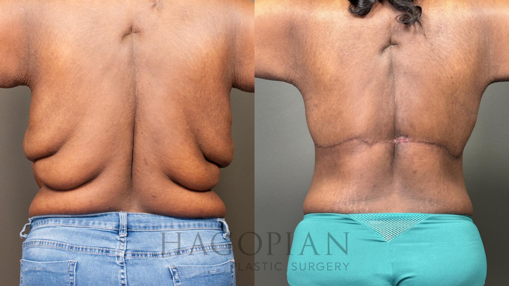 Before & After back lift Case 60 Back View in Atlanta, GA