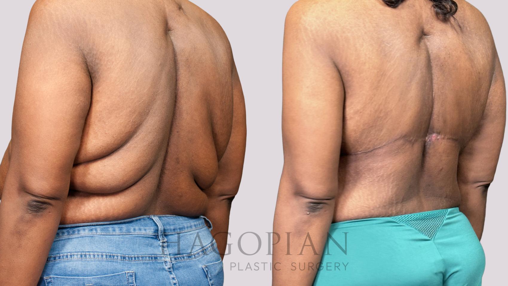 Before & After Back Lift Case 60 Left Oblique View in Atlanta, GA