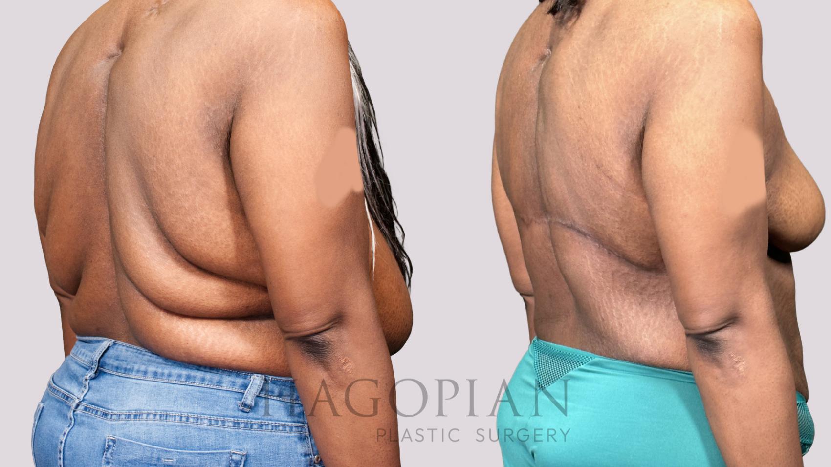 Before & After Back Lift Case 60 Right Oblique View in Atlanta, GA