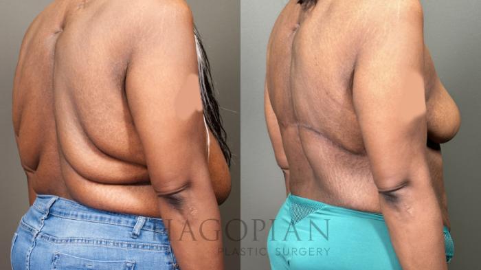 Before & After Back Lift Case 60 Right Oblique View in Atlanta, GA