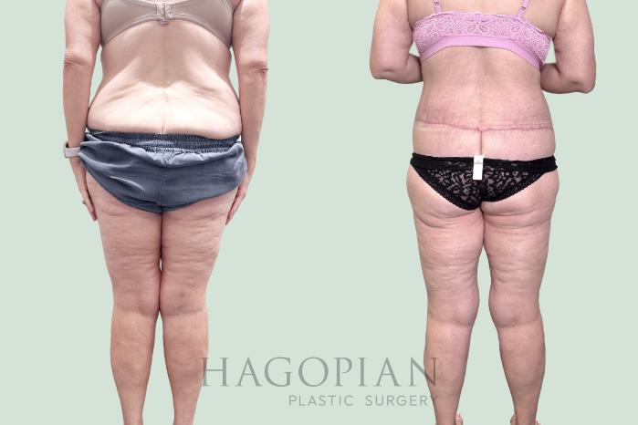 Before & After Lipedema Surgery Case 151 Back View in Atlanta, GA