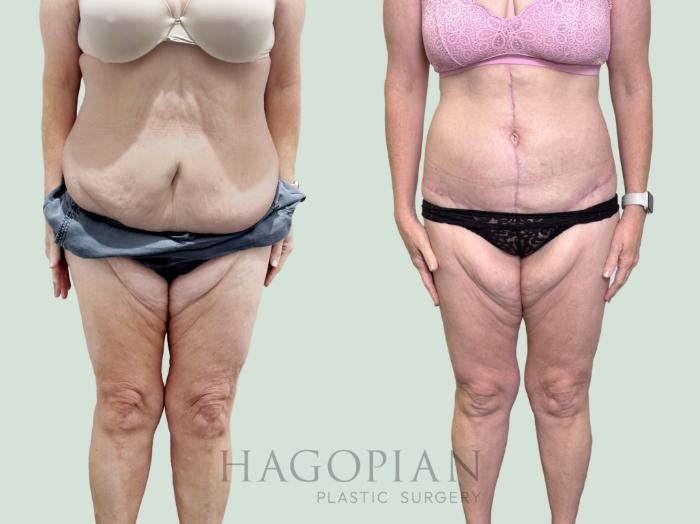 Before & After Drainless Tummy Tuck Case 151 Front View in Atlanta, GA