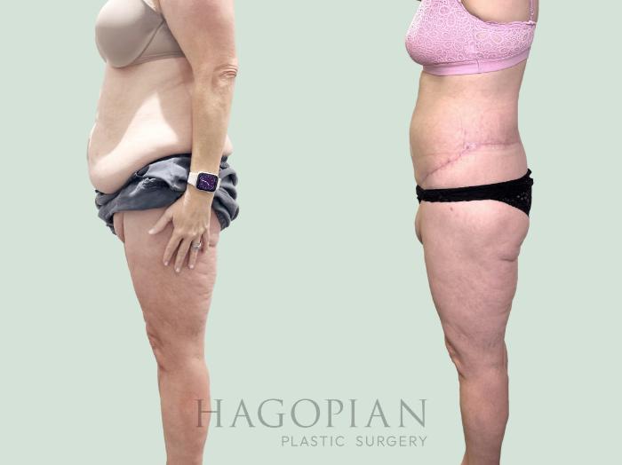 Before & After Lipedema Surgery Case 151 Left Side View in Atlanta, GA