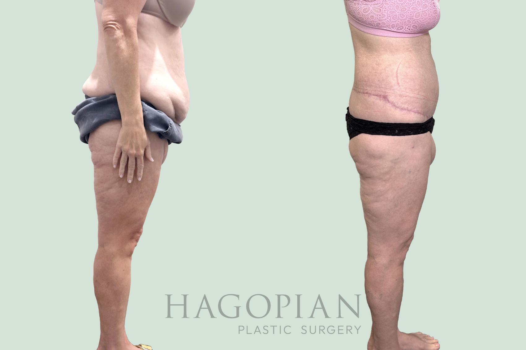 Before & After Body Lift Case 151 Right Side View in Atlanta, GA