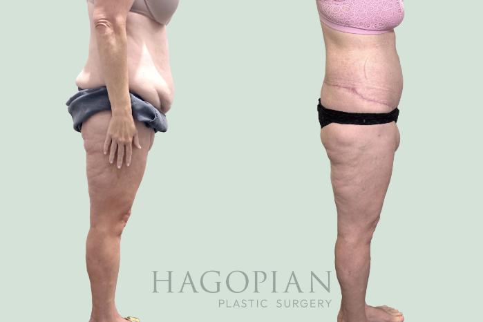 Before & After Lipedema Surgery Case 151 Right Side View in Atlanta, GA