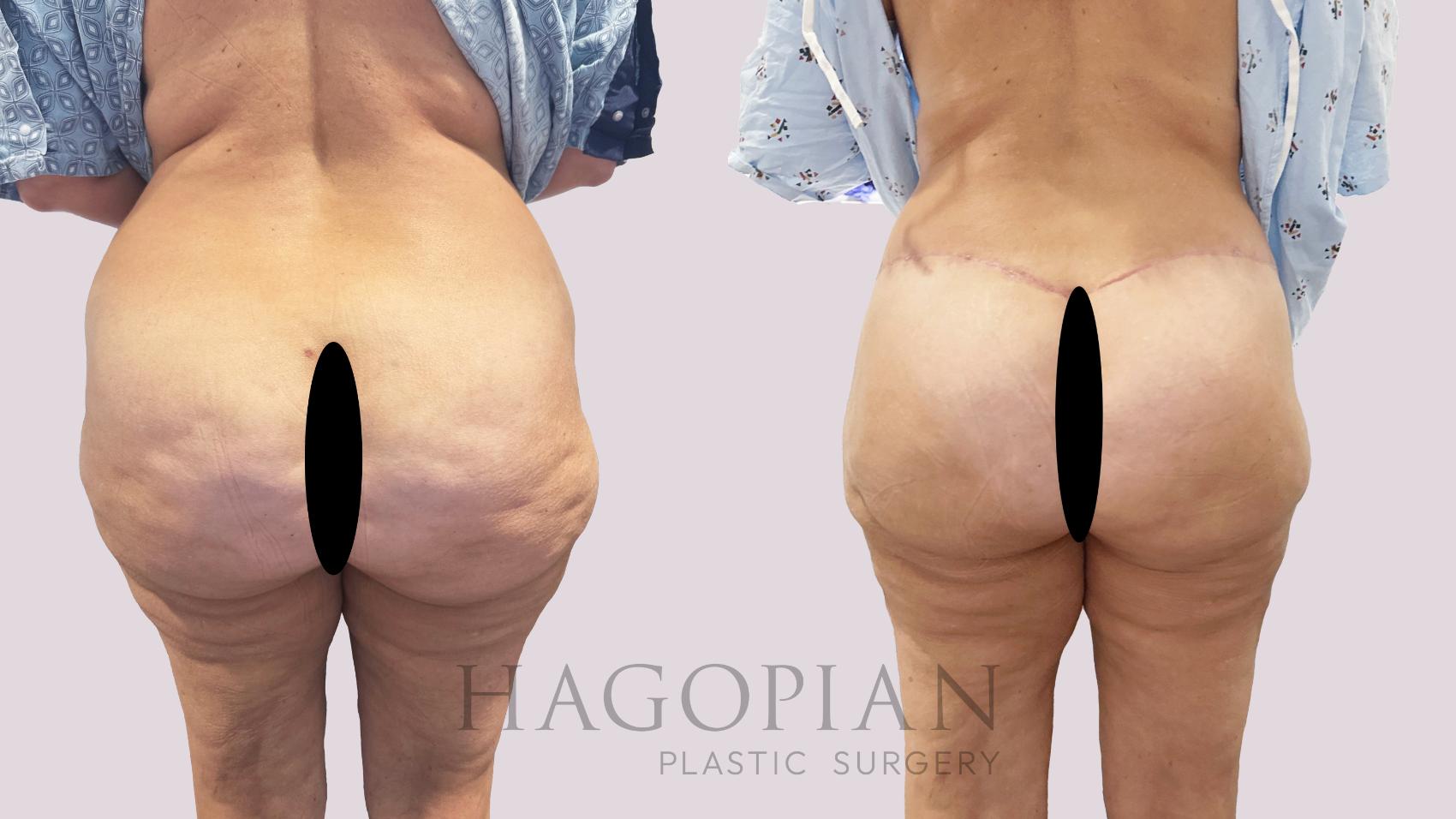 Before & After Drainless Tummy Tuck Case 185 Back View in Atlanta, GA