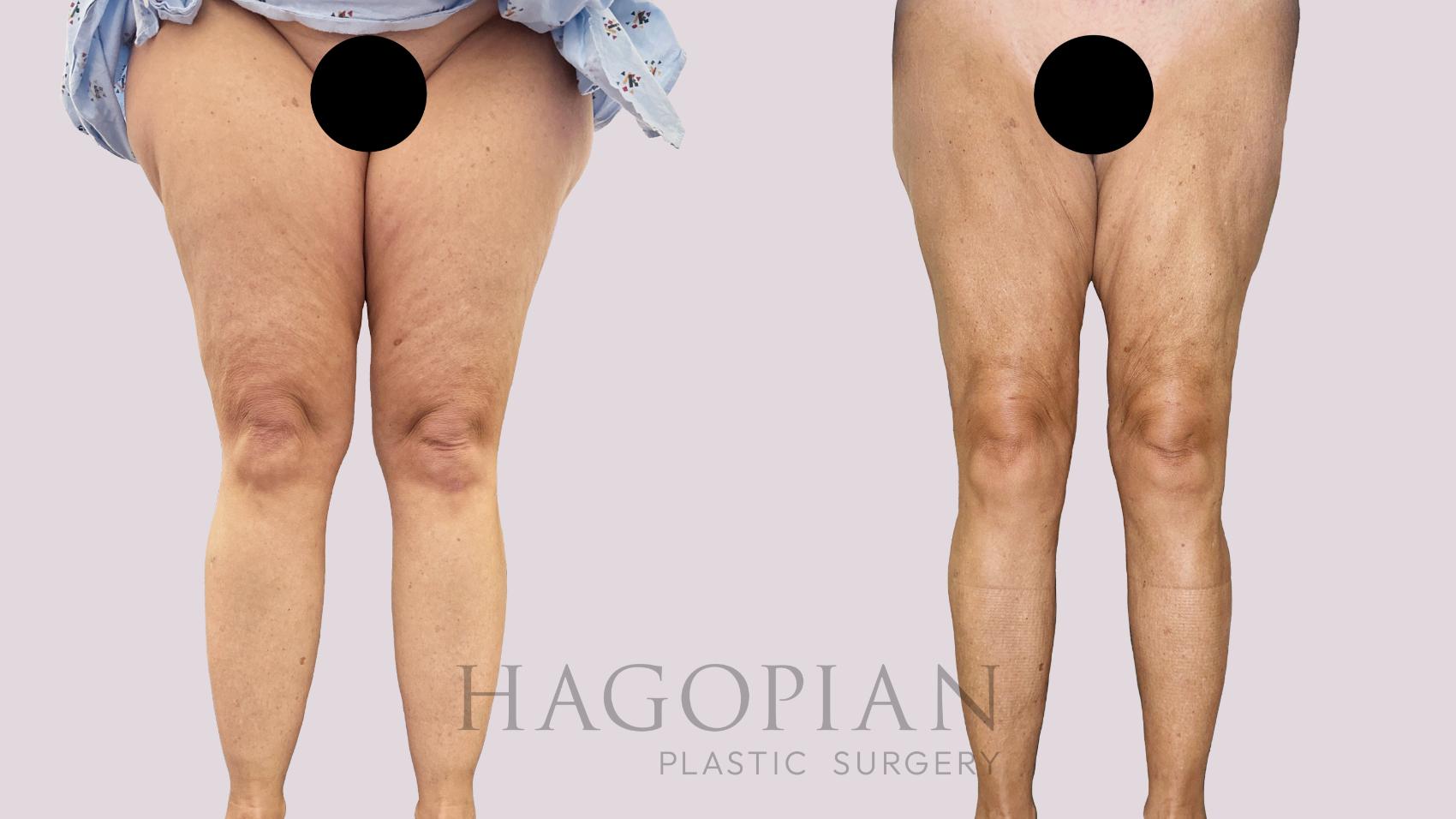 Before & After Drainless Tummy Tuck Case 185 Left Side View in Atlanta, GA