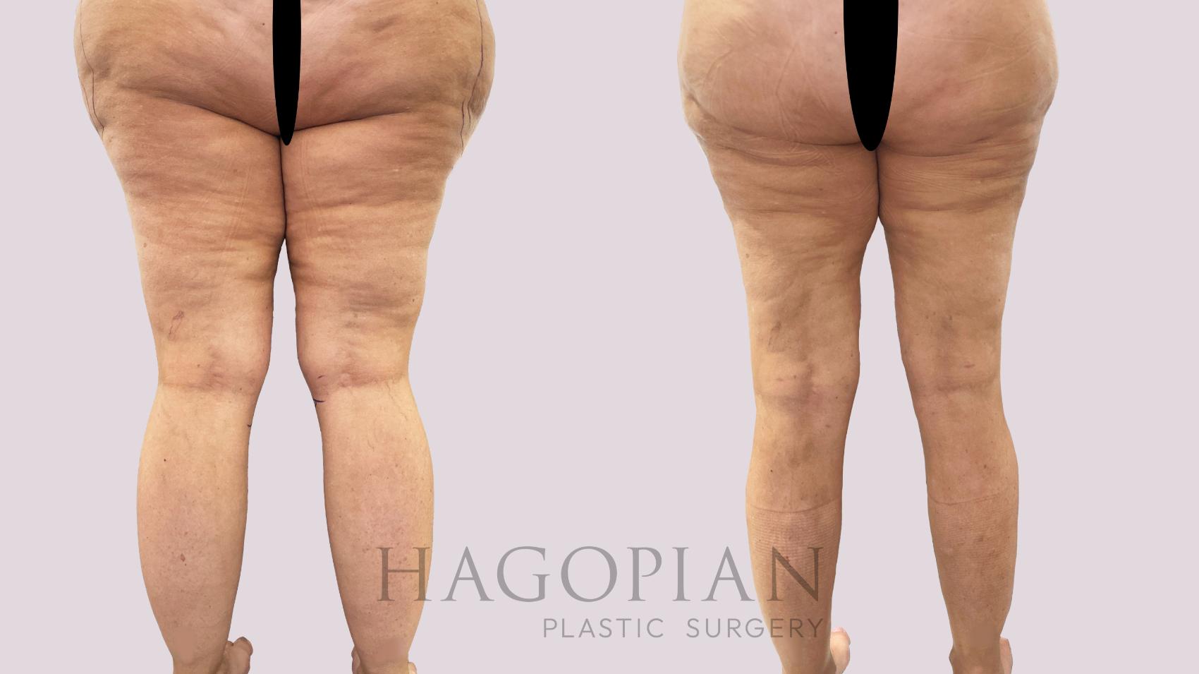 Before & After Drainless Tummy Tuck Case 185 Right Side View in Atlanta, GA
