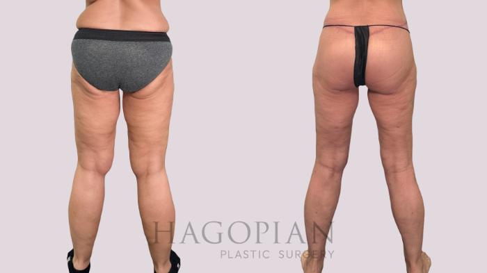 Before & After Body Lift Case 229 Back View in Atlanta, GA