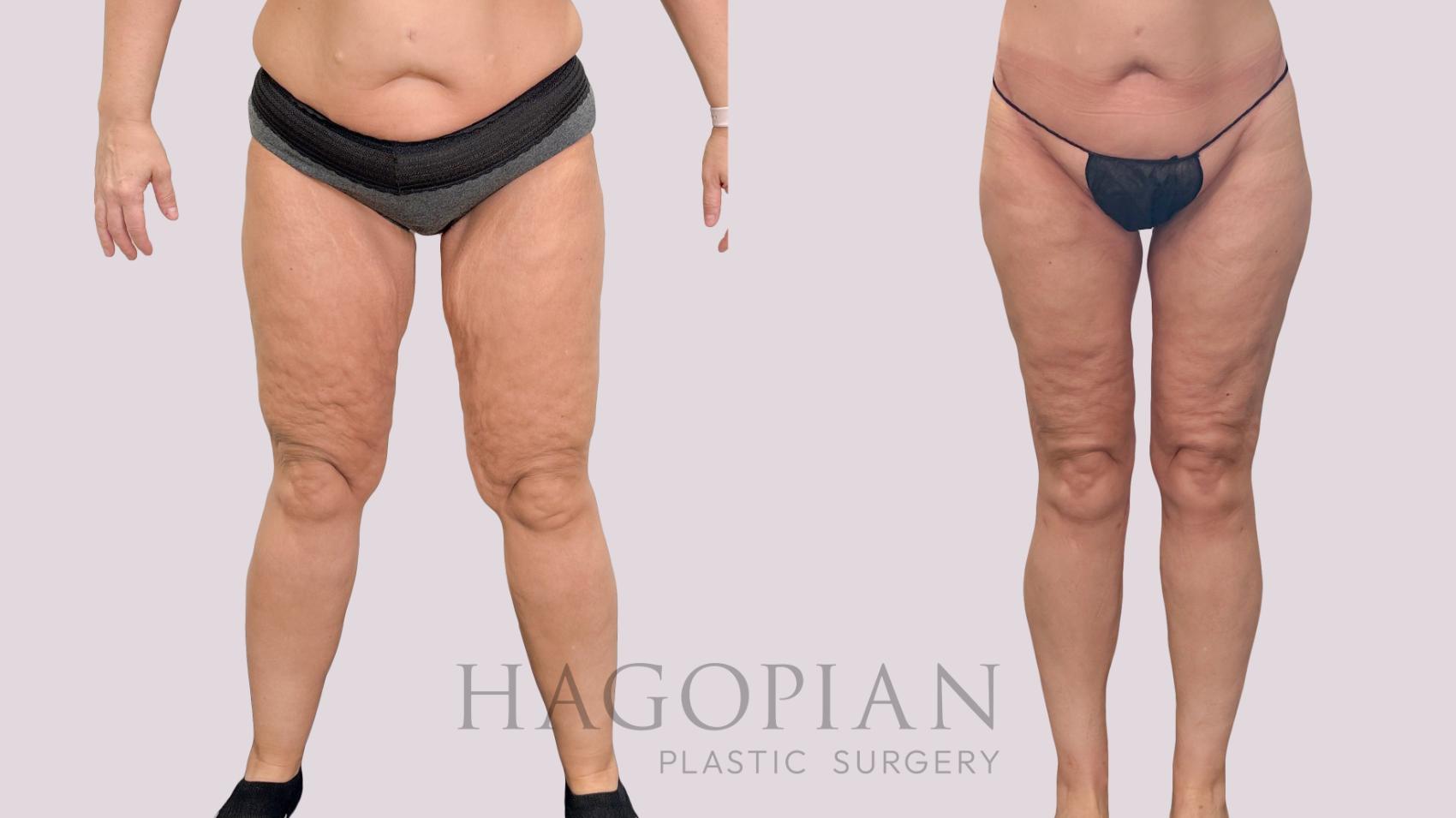 Before & After Body Lift Case 229 Front View in Atlanta, GA