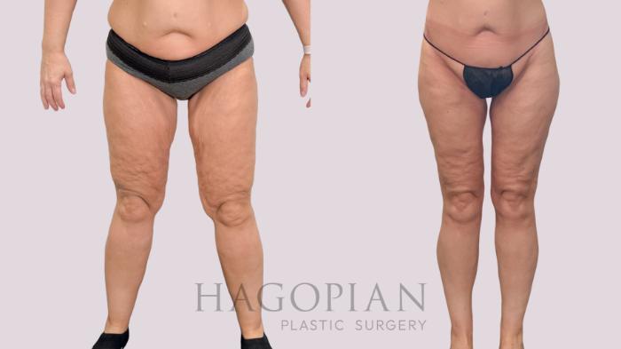 Before & After Body Lift Case 229 Front View in Atlanta, GA