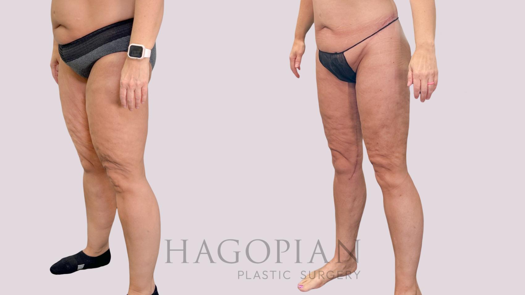 Before & After Body Lift Case 229 Left Oblique View in Atlanta, GA