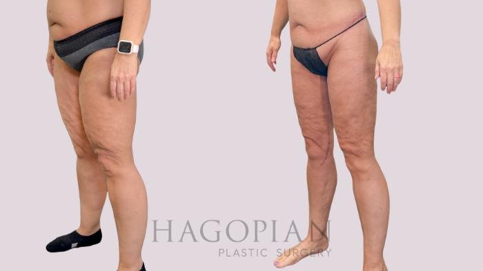 Before & After Body Lift Case 229 Left Oblique View in Atlanta, GA