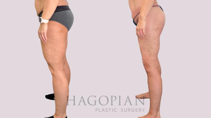 Before & After Body Lift Case 229 Left Side View in Atlanta, GA
