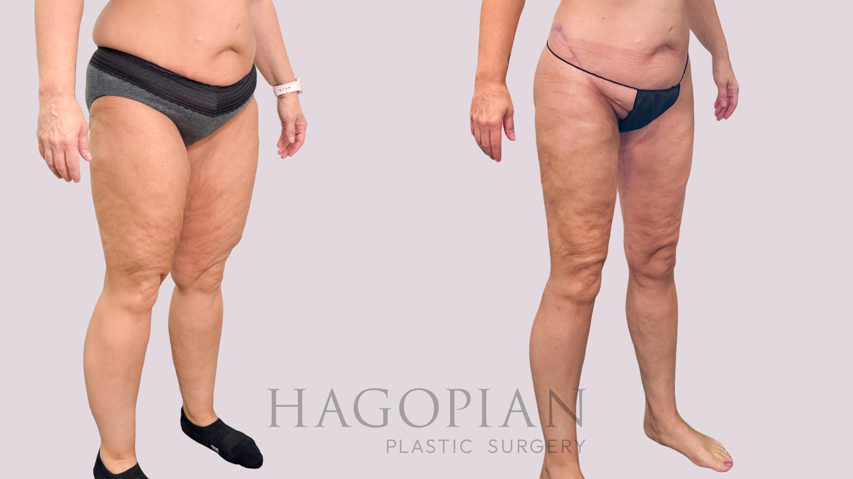 Before & After Body Lift Case 229 Right Oblique View in Atlanta, GA