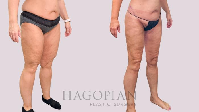 Before & After Body Lift Case 229 Right Oblique View in Atlanta, GA