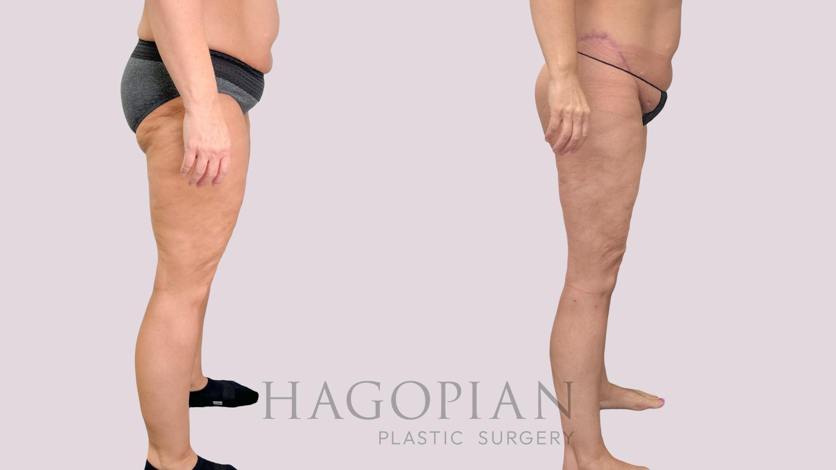 Before & After Body Lift Case 229 Right Side View in Atlanta, GA