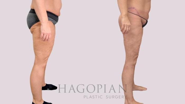 Before & After Body Lift Case 229 Right Side View in Atlanta, GA