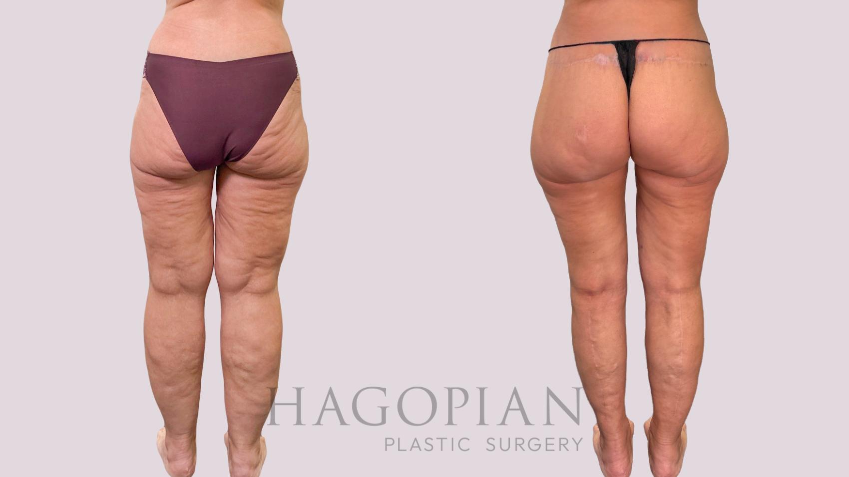 Before & After Body Lift Case 230 Back View in Atlanta, GA