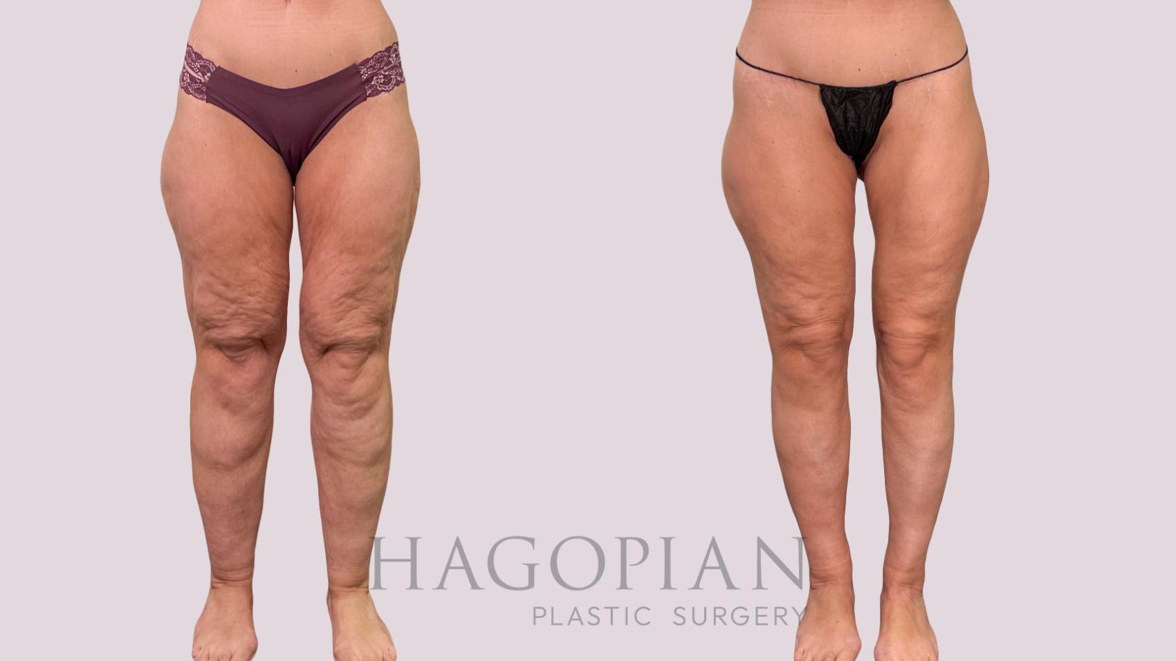 Before & After Body Lift Case 230 Front View in Atlanta, GA