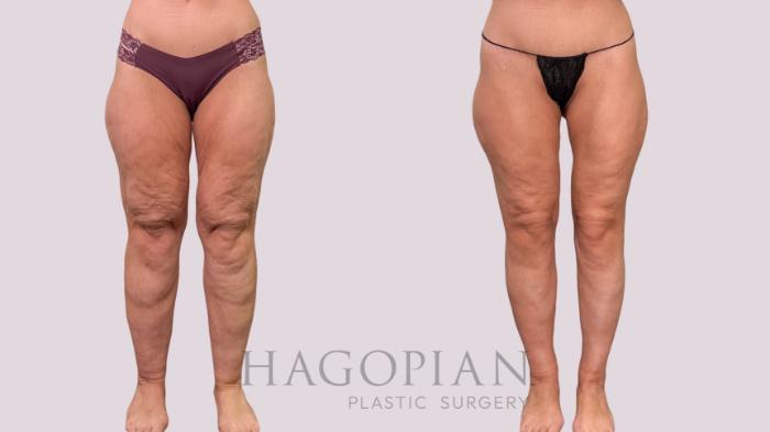 Before & After Body Lift Case 230 Front View in Atlanta, GA