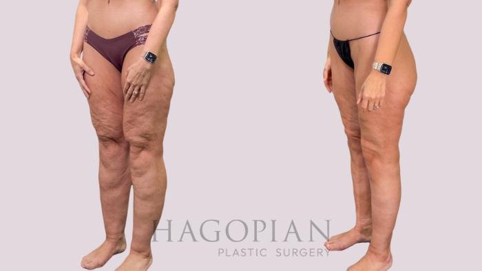 Before & After Body Lift Case 230 Left Oblique View in Atlanta, GA