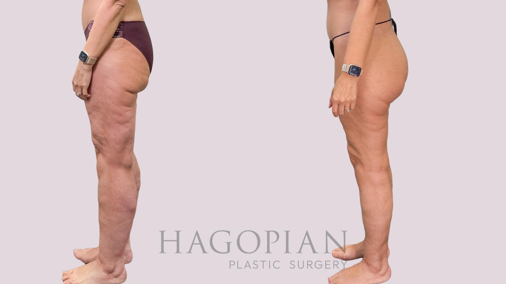 Before & After Body Lift Case 230 Left Side View in Atlanta, GA