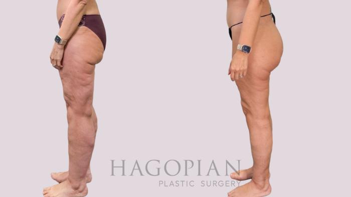 Before & After Body Lift Case 230 Left Side View in Atlanta, GA