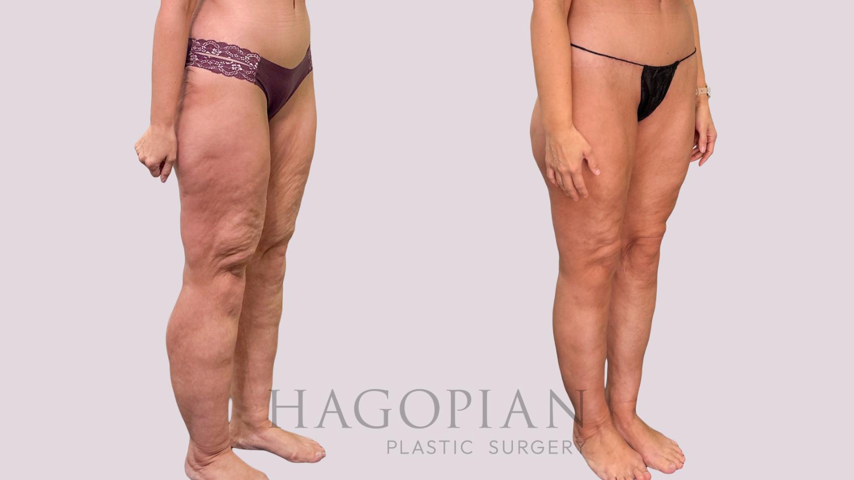 Before & After Body Lift Case 230 Right Oblique View in Atlanta, GA