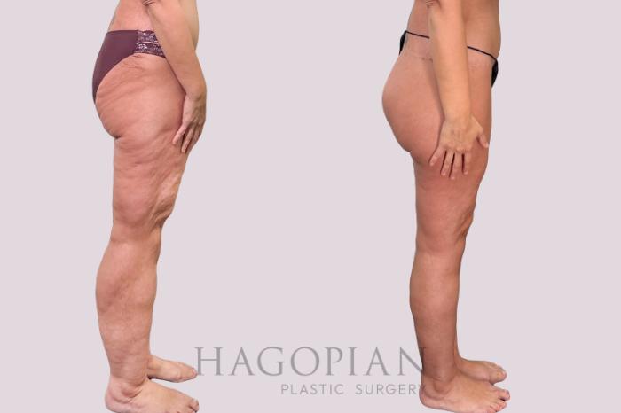 Before & After Body Lift Case 230 Right Side View in Atlanta, GA