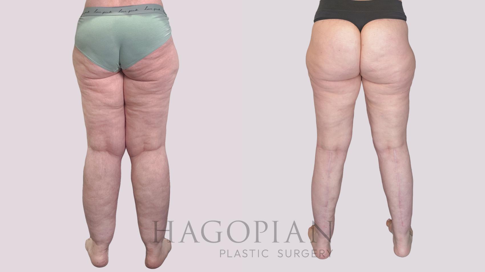 Before & After Body Lift Case 273 Back View in Atlanta, GA