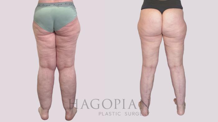 Before & After Body Lift Case 273 Back View in Atlanta, GA