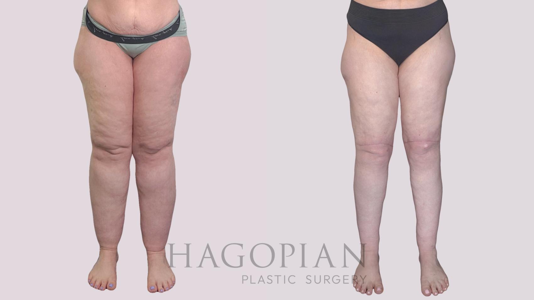 Before & After Body Lift Case 273 Front View in Atlanta, GA