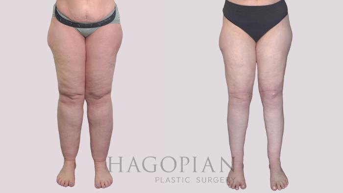 Before & After Body Lift Case 273 Front View in Atlanta, GA