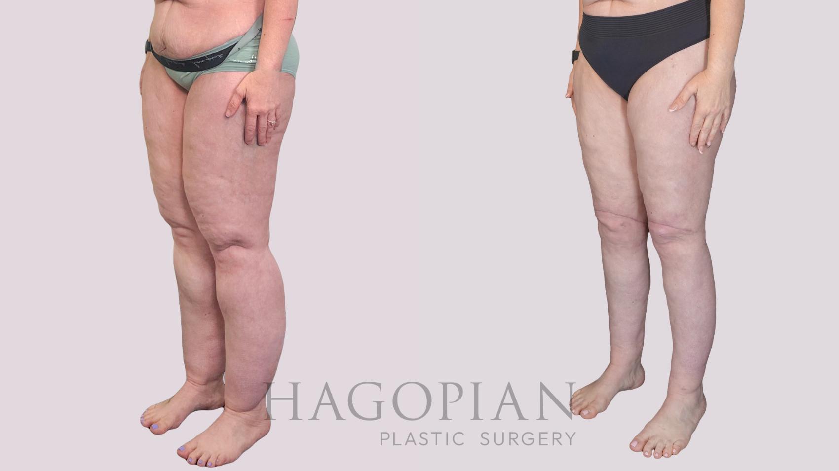 Before & After Body Lift Case 273 Left Oblique View in Atlanta, GA