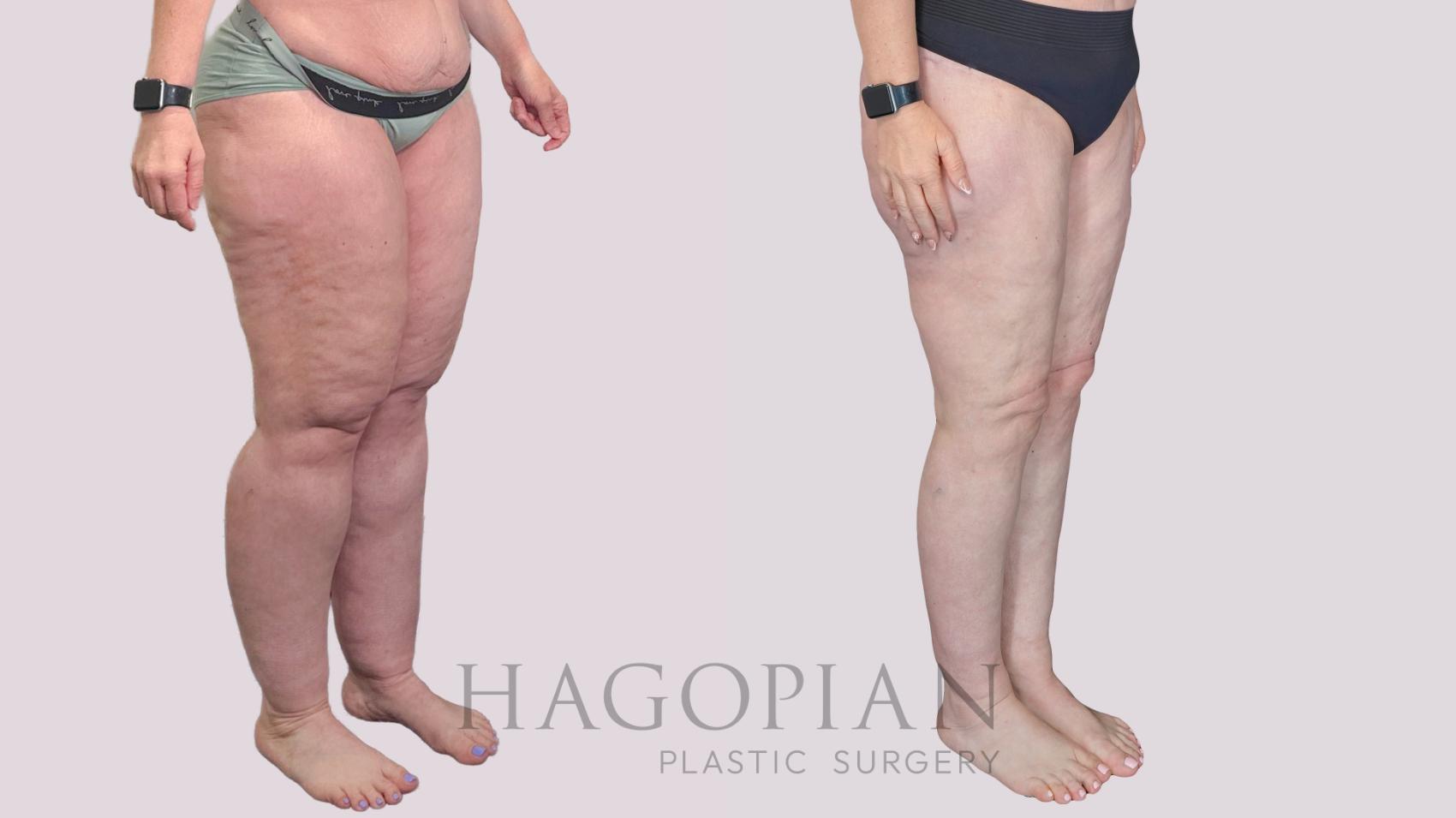 Before & After Body Lift Case 273 Right Oblique View in Atlanta, GA