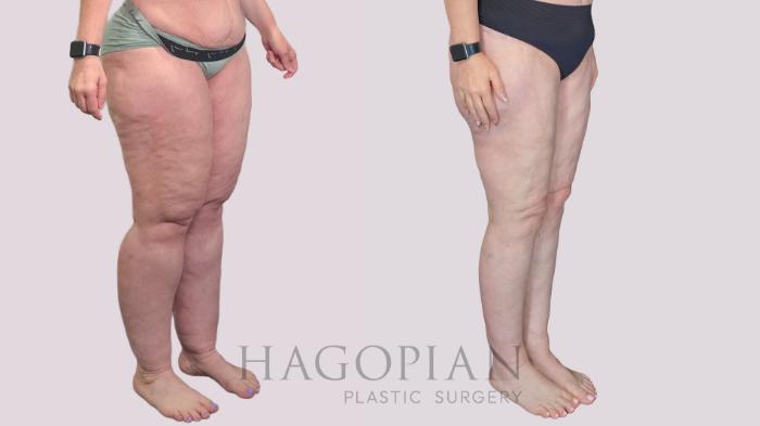 Before & After Body Lift Case 273 Right Oblique View in Atlanta, GA