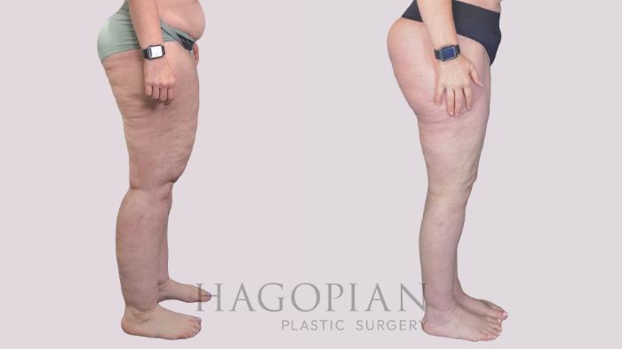 Before & After Body Lift Case 273 Right Side View in Atlanta, GA