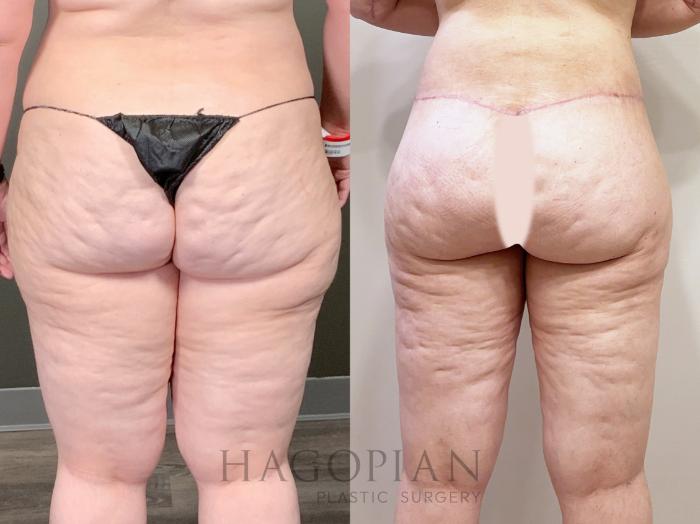 Before & After Lipedema Surgery Case 96 Back View in Atlanta, GA