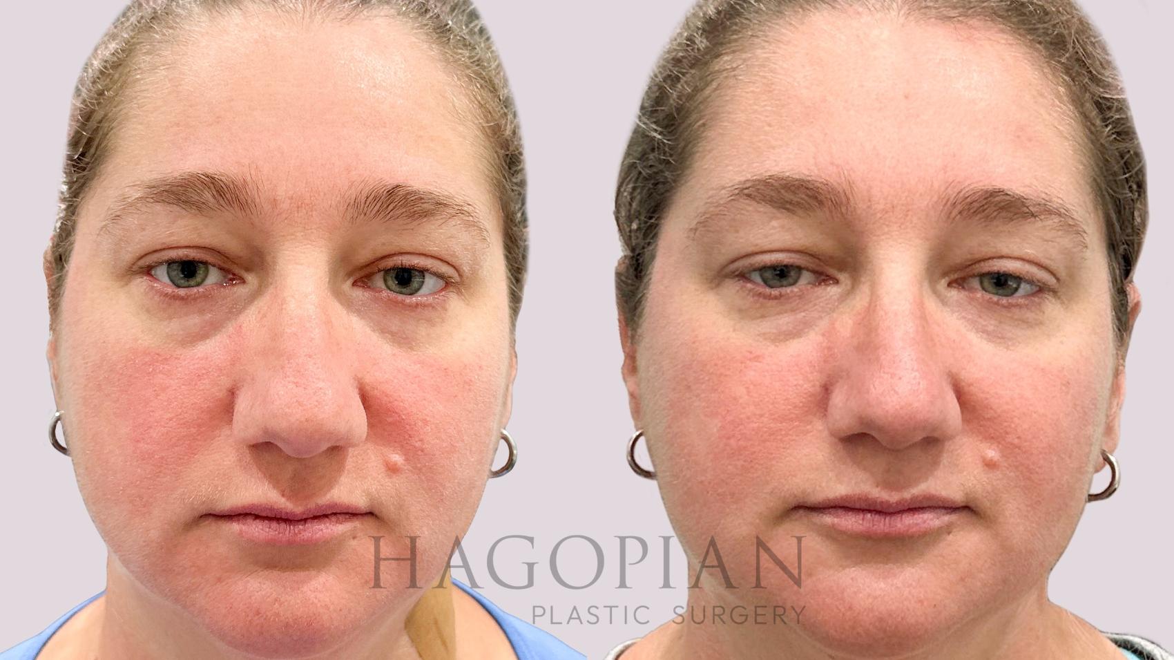 Before & After BOTOX® Cosmetic Case 202 Front View in Atlanta, GA