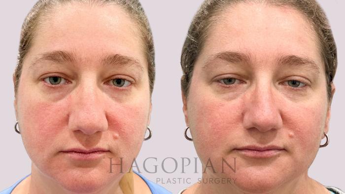 Before & After BOTOX® Cosmetic Case 202 Front View in Atlanta, GA
