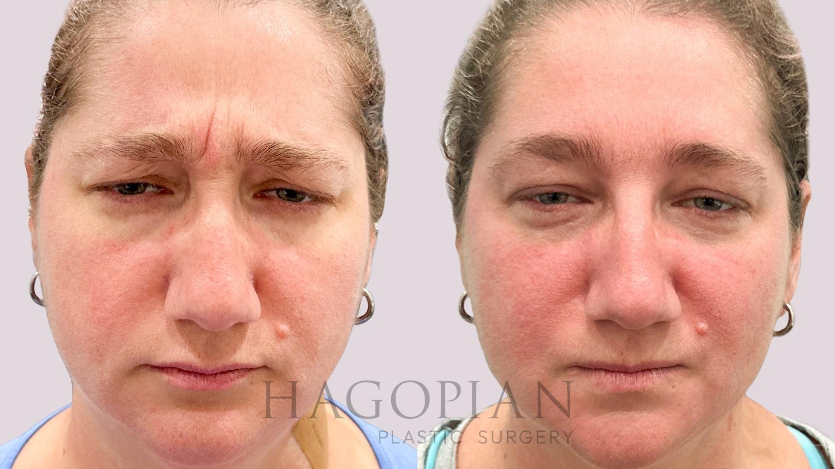 Before & After BOTOX® Cosmetic Case 202 Scowl View in Atlanta, GA