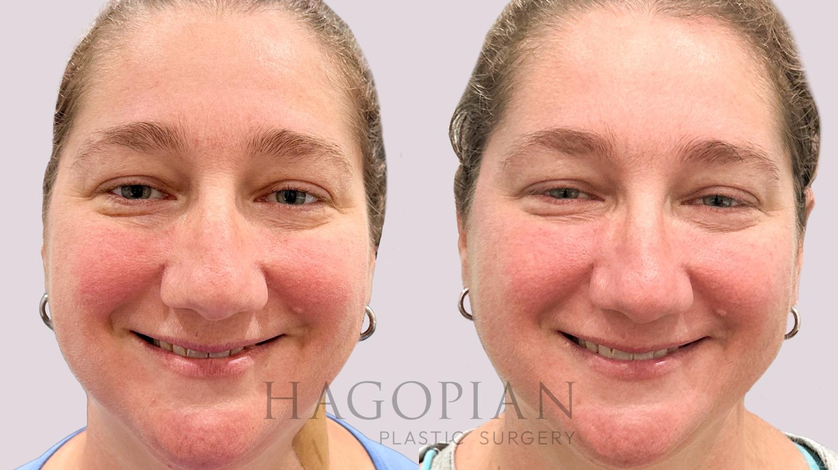 Before & After BOTOX® Cosmetic Case 202 Smile View in Atlanta, GA